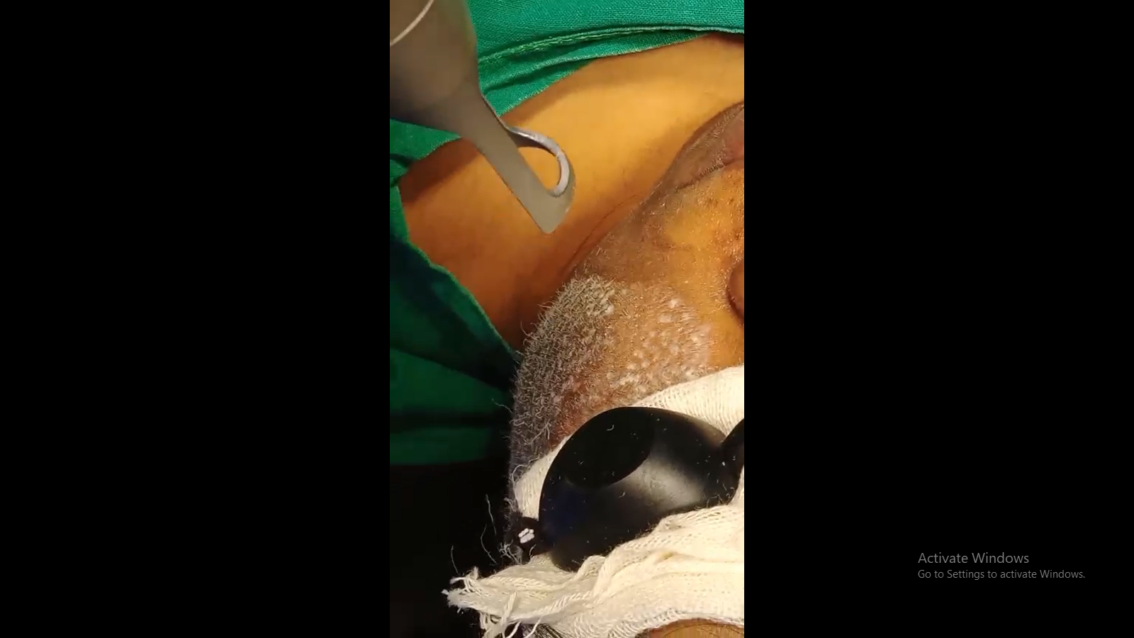 Cryolipolysis